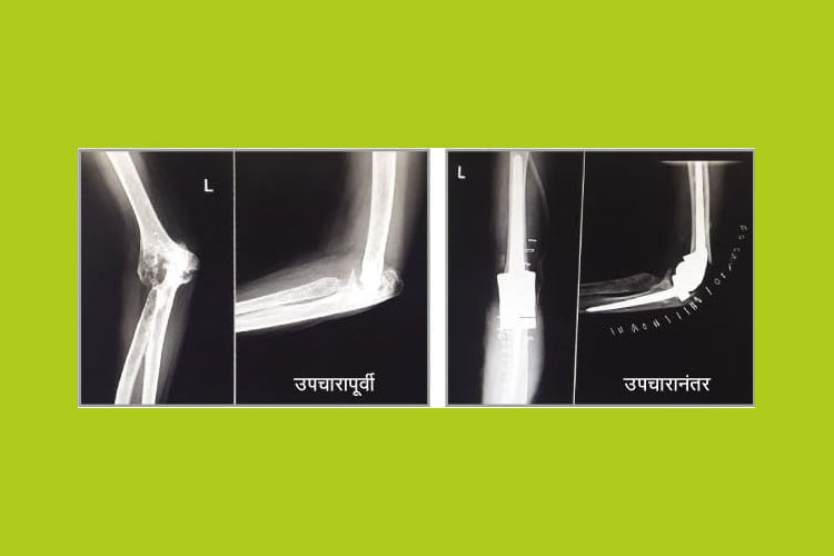Successful Surgery carried out on artificial joint implant at the hospital
